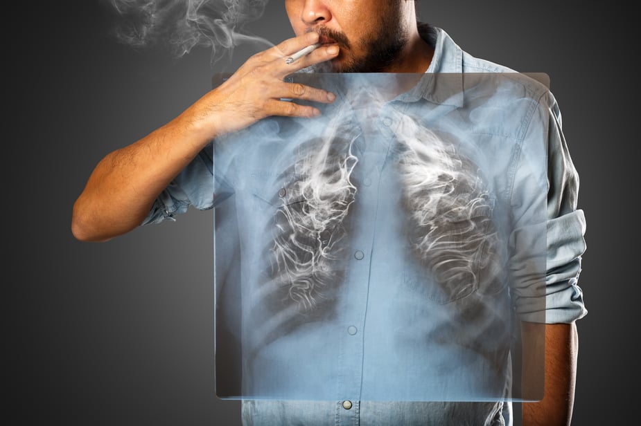 7 Surprising Signs and Symptoms of Lung Cancer